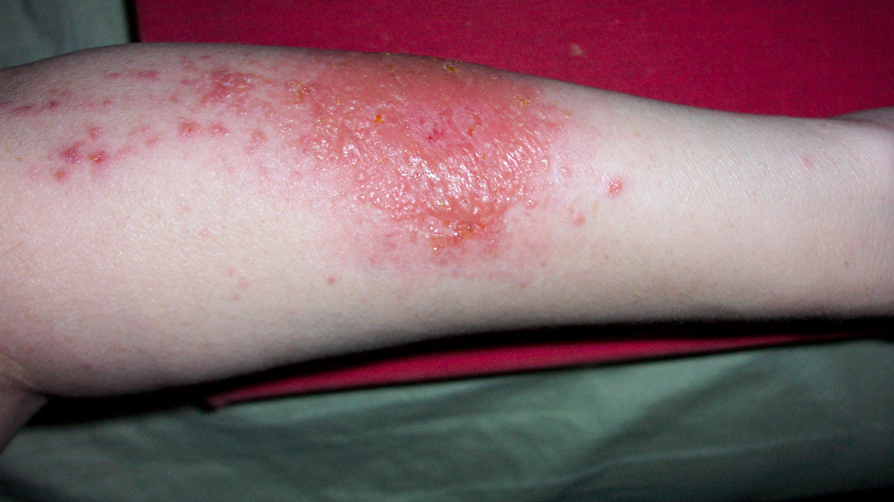 Poison Ivy Rash: Pictures, Symptoms, and Treatment